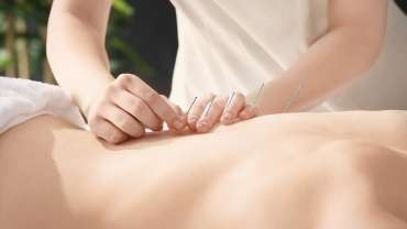 Acupuncture